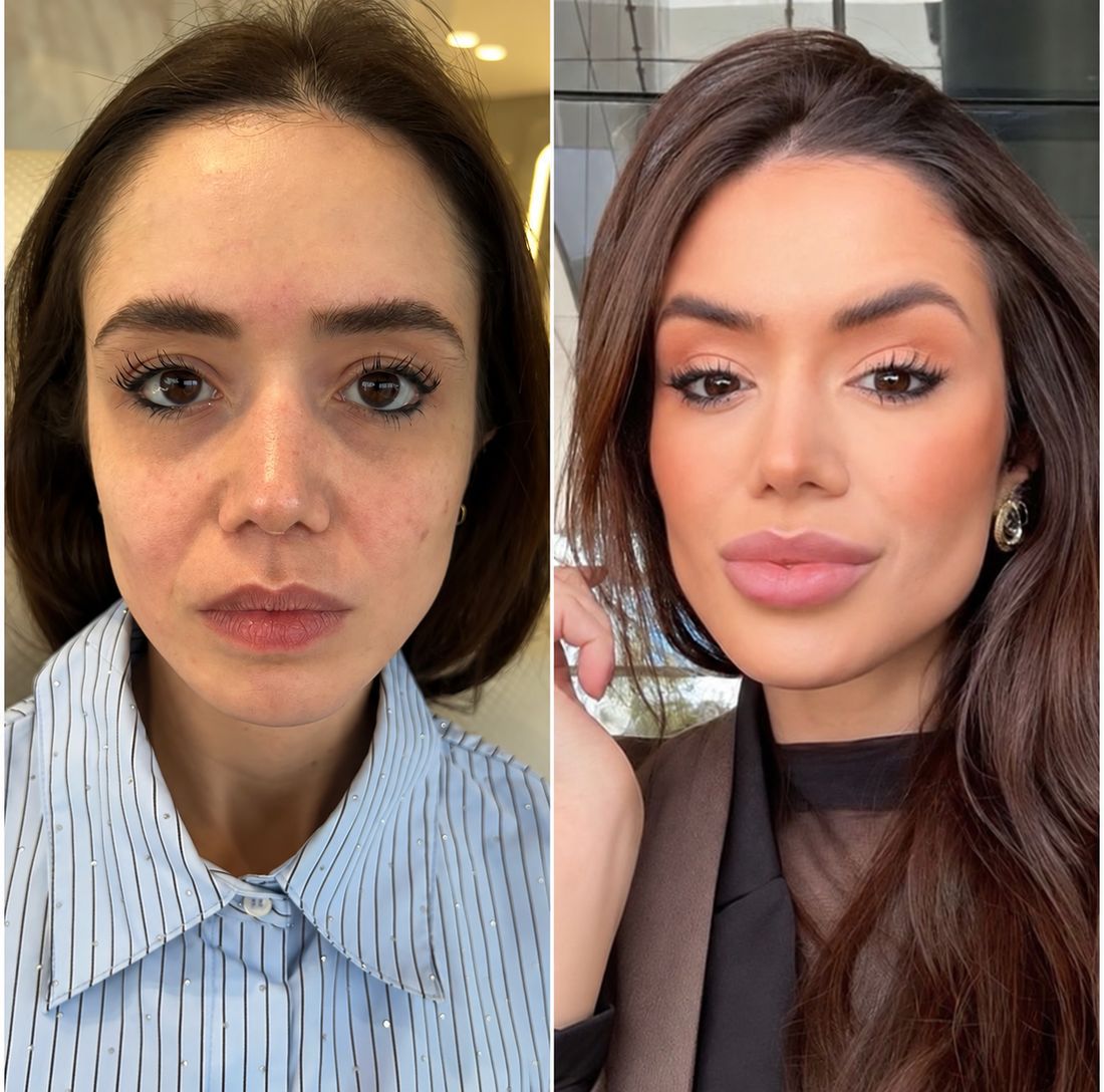 Antes e depois — paciente 02